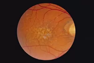 Images Dated 9th July 2003: Macular degeneration