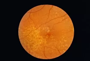 Images Dated 9th July 2003: Macular degeneration