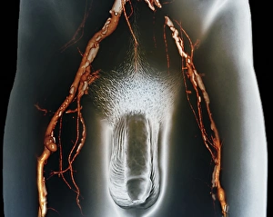 Narrowed arteries, 3D CT scan F006/9113 Narrowed arteries, 3D CT scan F006/9113