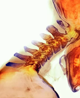 Spine Gallery: Neck vertebrae extended, X-ray