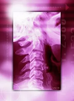 Spine Gallery: Neck, side view, coloured X-ray
