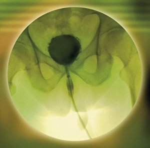 Normal Bladder Print, Coloured Cystogram