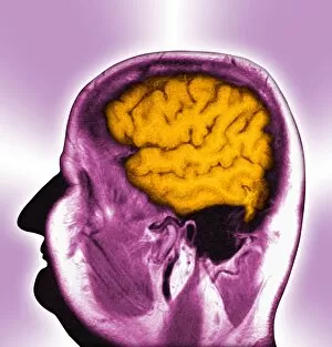 Normal brain, MRI scan