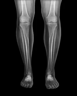 X Ray Machine Collection: Normal legs, X-rays