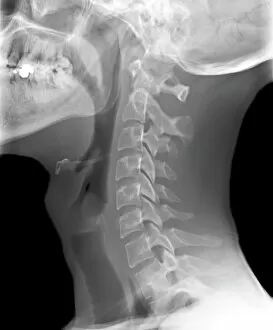 Vertebra Gallery: Normal neck, X-ray
