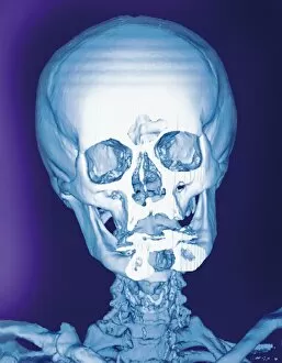 Frontal Gallery: Normal skull, X-ray