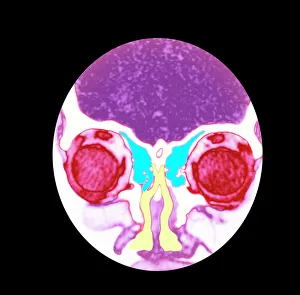 Facial Gallery: Nose and sinuses, CT scan
