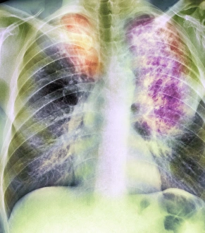 Old and new tuberculosis, X-ray Old and new tuberculosis, X-ray