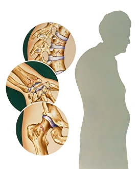 Images Dated 13th March 2002: Osteoporosis