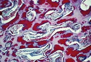 Images Dated 4th April 2003: Osteoporotic bone