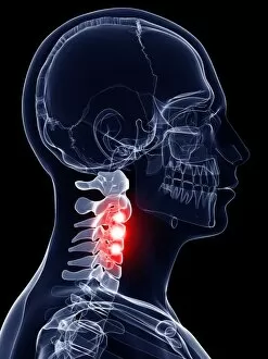 Cervical Spine Gallery: Painful cervical spine, artwork F007 / 6178