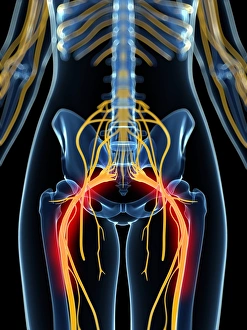 Painful sciatic nerve artwork F007/7011 Painful sciatic nerve artwork F007/7011