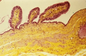 Paratubal cysts, light micrograph C015/6410 Paratubal cysts, light micrograph C015/6410