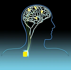 Impulses Gallery: Parkinsons disease treatment, artwork