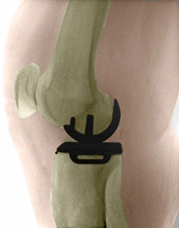 Partial Knee Replacement Partial Knee Replacement