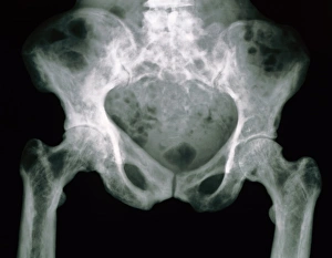Pelvis in Pagets disease Pelvis in Pagets disease
