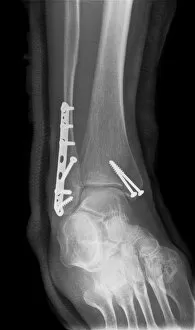 Pinned boken ankle, X-ray C017 / 7186