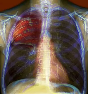 Images Dated 8th December 2003: Pneumonia, X-ray