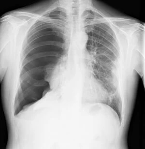 X Ray Machine Collection: Pneumothorax, X-ray C017 / 7148