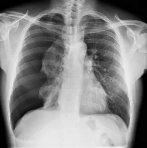 Xray Collection: Pneumothorax, X-ray C017 / 7812