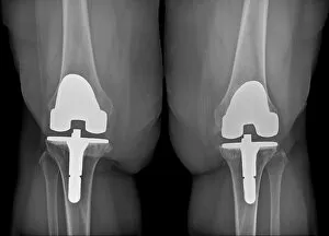 Xray Collection: Prosthetic knees and obesity, X-ray C016 / 6596