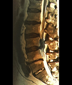 Sciatica, MRI scan Sciatica, MRI scan