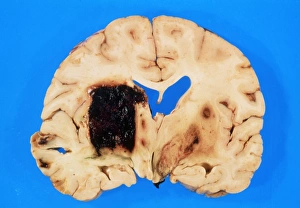Section of brain showing intracerebral haemorrhage Section of brain showing intracerebral haemorrhage