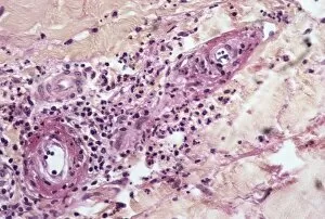 Images Dated 12th November 2003: Skin inflammation, light micrograph