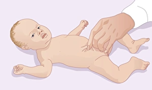 Skin pinch test for dehydration, artwork Skin pinch test for dehydration, artwork