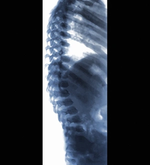Spine in Hurler Syndrome, X-ray Spine in Hurler Syndrome, X-ray