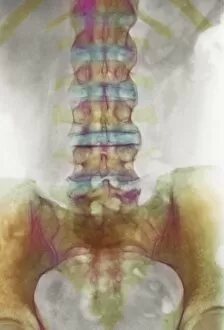 Back Bone Gallery: Spondylitis, X-ray