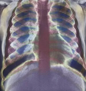 Images Dated 15th January 2003: Thalassaemia, X-ray