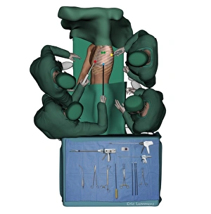 Thorascopic surgery, artwork C016/6842 Thorascopic surgery, artwork C016/6842