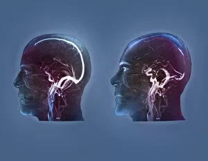 Thrombophlebitis in the brain, MRI scans