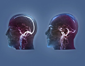 Thrombophlebitis in the brain, MRI scans Thrombophlebitis in the brain, MRI scans