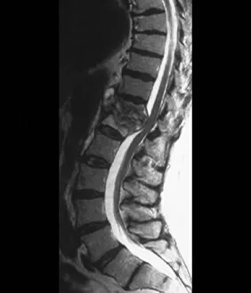 Central Nervous System Gallery: Tuberculosis of the spine, MRI scan