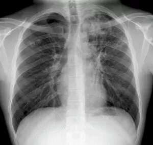 Images Dated 10th August 2011: Tuberculosis, X-ray