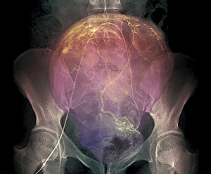 Uterine bleeding treatment, DSA scan Uterine bleeding treatment, DSA scan