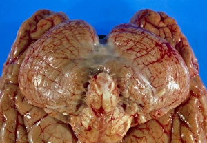 View of undersurface of brain with meningitis View of undersurface of brain with meningitis