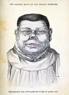 Cretin aged 15. Cretinism in infants and children is caused by defective thyroid gland Cretin aged 15. Cretinism in infants and children is caused by defective thyroid gland