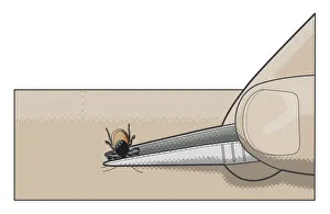 Digital illustration showing removal of tick from human skin using tweezers Digital illustration showing removal of tick from human skin using tweezers