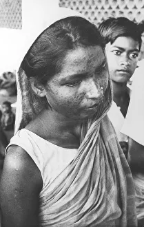 Indian woman with Smallpox scars