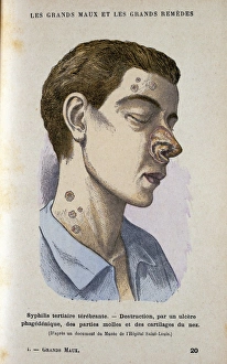 Man suffering from tertiary Syphilis. From Jules Rengade Le Grands Maux et les Grands Man suffering from tertiary Syphilis. From Jules Rengade Le Grands Maux et les Grands