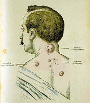 Pustules in man suffering from Anthrax Pustules in man suffering from Anthrax