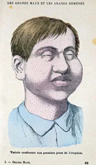Smallpox victim. From French medical book c1890 Smallpox victim. From French medical book c1890