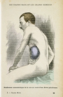 Typical enlarged spleen of a Malaria patient. Malaria is caused by a parasitic protozoa Typical enlarged spleen of a Malaria patient. Malaria is caused by a parasitic protozoa