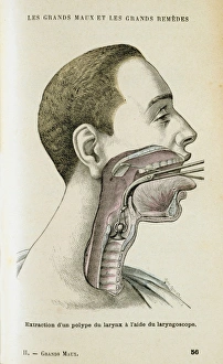 Using a laryngoscope to aid a surgeon in the removal of a polyp from the throat, c1890 Using a laryngoscope to aid a surgeon in the removal of a polyp from the throat, c1890
