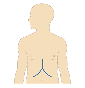 Biomedical illustration of incision site for liver transplant Biomedical illustration of incision site for liver transplant