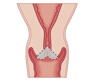 Cross section biomedical illustration of Cervical conization biopsy of cervical intraepithelial neoplasia Cross section biomedical illustration of Cervical conization biopsy of cervical intraepithelial neoplasia