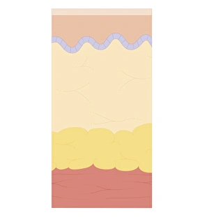 Cross section biomedical illustration of degrees of severity of burns Cross section biomedical illustration of degrees of severity of burns